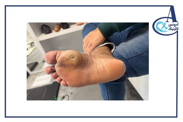 زخم پای دیابتی-ادونس کلینیک